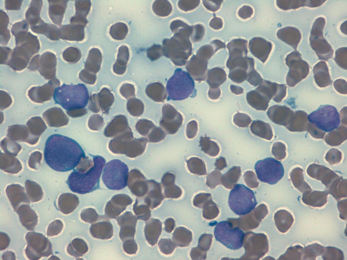 Peripheral blood extension ALL